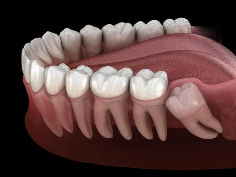 Denti del giudizio quando e perchè toglierli